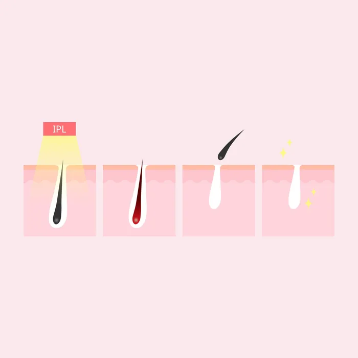 ShhhSof Female Sex Toys Silhouette Portable Laser Hair Remover Permanent Epliation System for Body Face