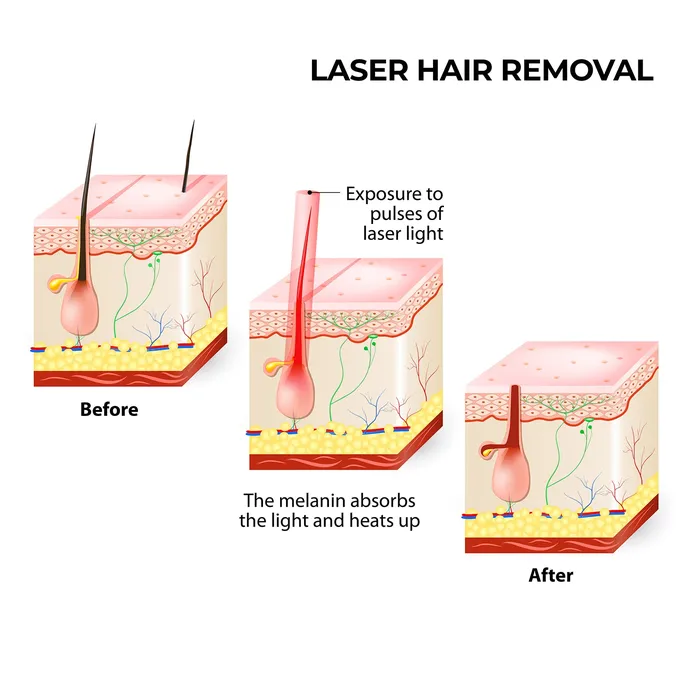 ShhhSof Female Sex Toys Silhouette Portable Laser Hair Remover Permanent Epliation System for Body Face