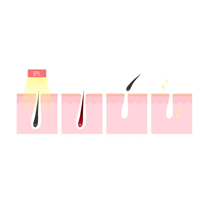 ShhhSof Female Sex Toys Silhouette Portable Laser Hair Remover Permanent Epliation System for Body Face